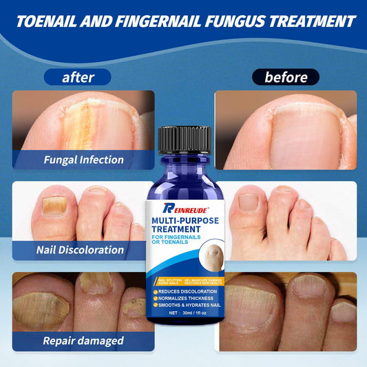BestBy01/27 Toenail Fungus Treatment Extra Strength with Tolnaftate MultiPurpose