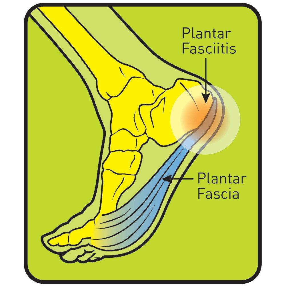 PROFOOT Plantar Fasciitis Orthotics Women's Size 6-10, 2 Pairs Heel Support