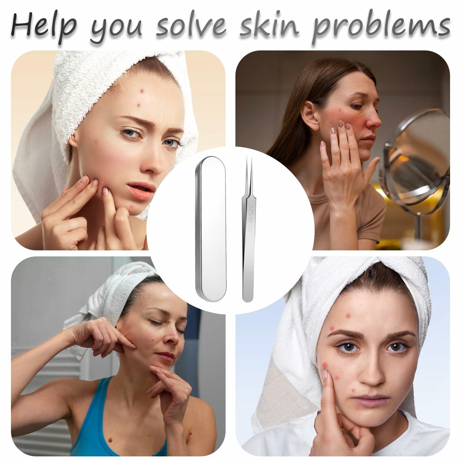 Bewudy 3Pc Stainless Steel Blackhead Remover Tweezers Kit Precision Tool