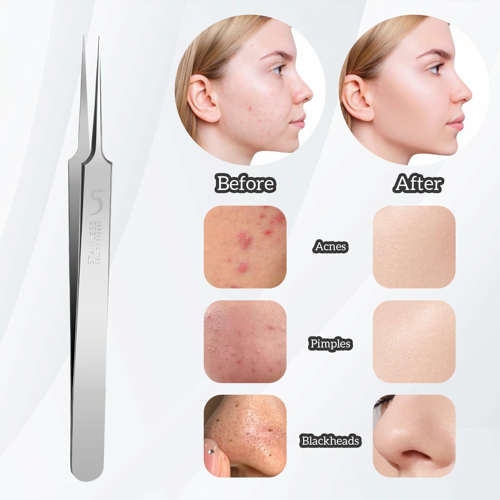 Bewudy 3Pc Stainless Steel Blackhead Remover Tweezers Kit Precision Tool