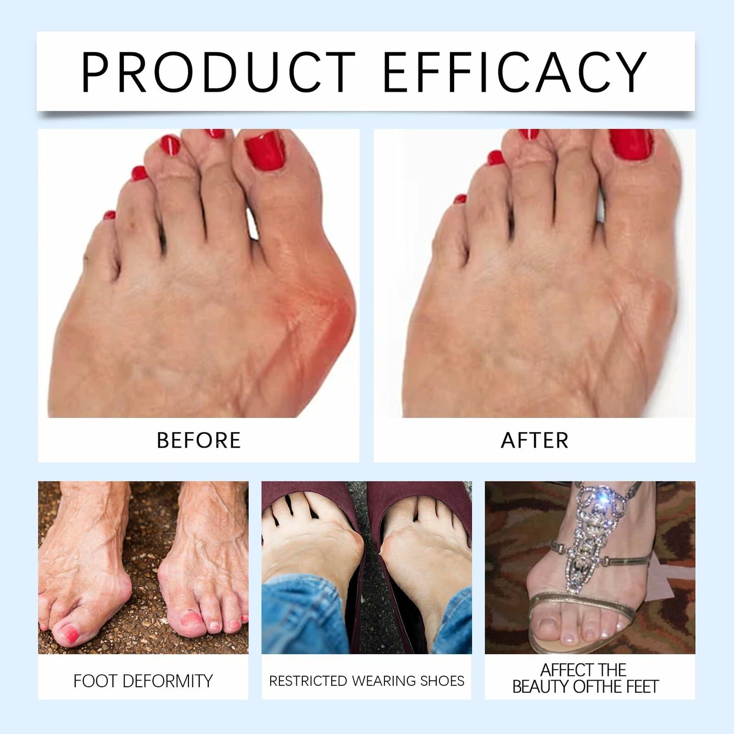 Befada Bunion Cushions Patch Waterproof Adhesive Pads for Men & Women 10 Tablets