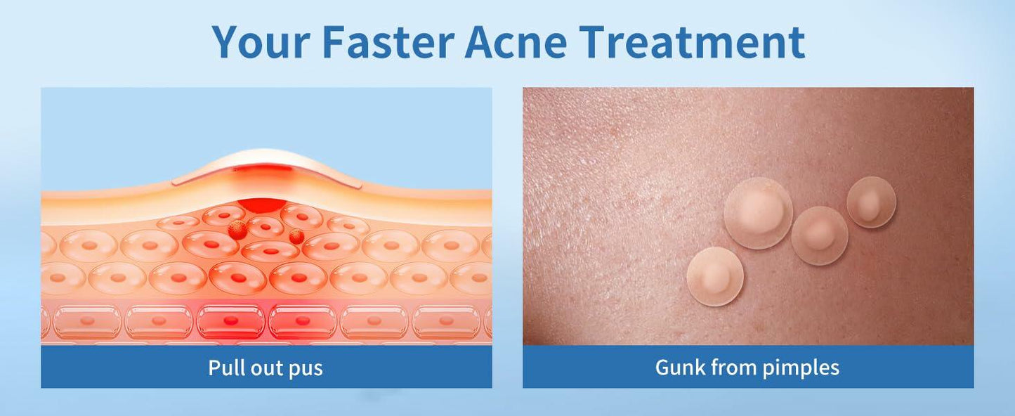 Chic Glamour Emporium Pimple Patch Hydrocolloid Acne Spot Stickers 72 Count