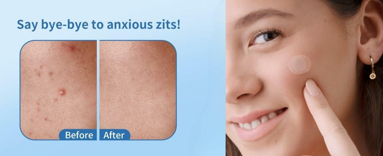 Chic Glamour Emporium Pimple Patch Hydrocolloid Acne Spot Stickers 72 Count