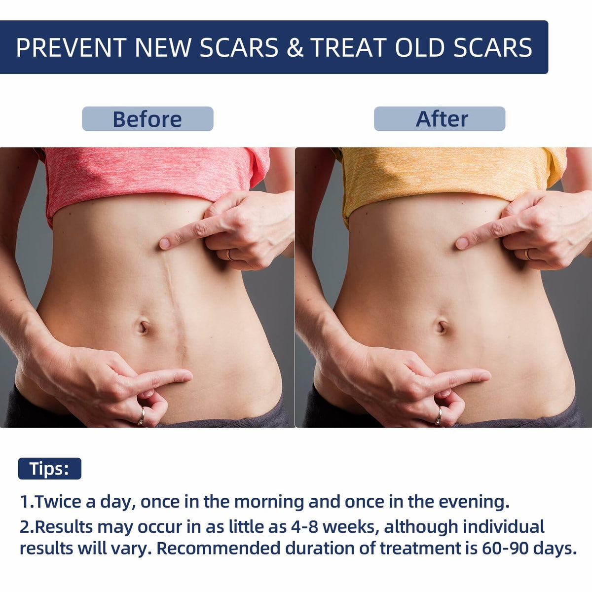 URAY Silicone Scar Gel Cream for Face & Body 30g BestBy01/27