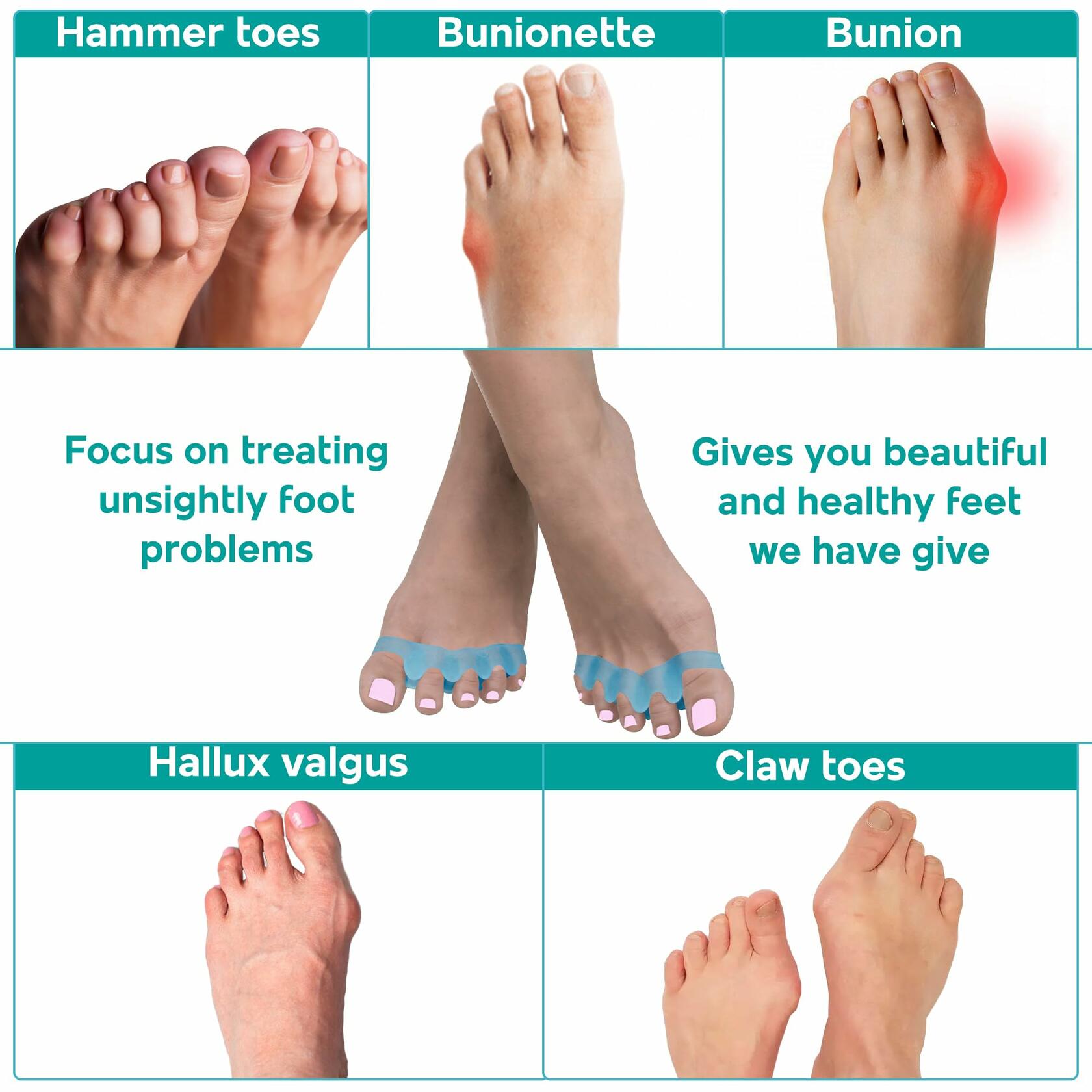 NAMELESS NICHE Toe Separators Bunion Corrector Toe Spacers White 1 Pair