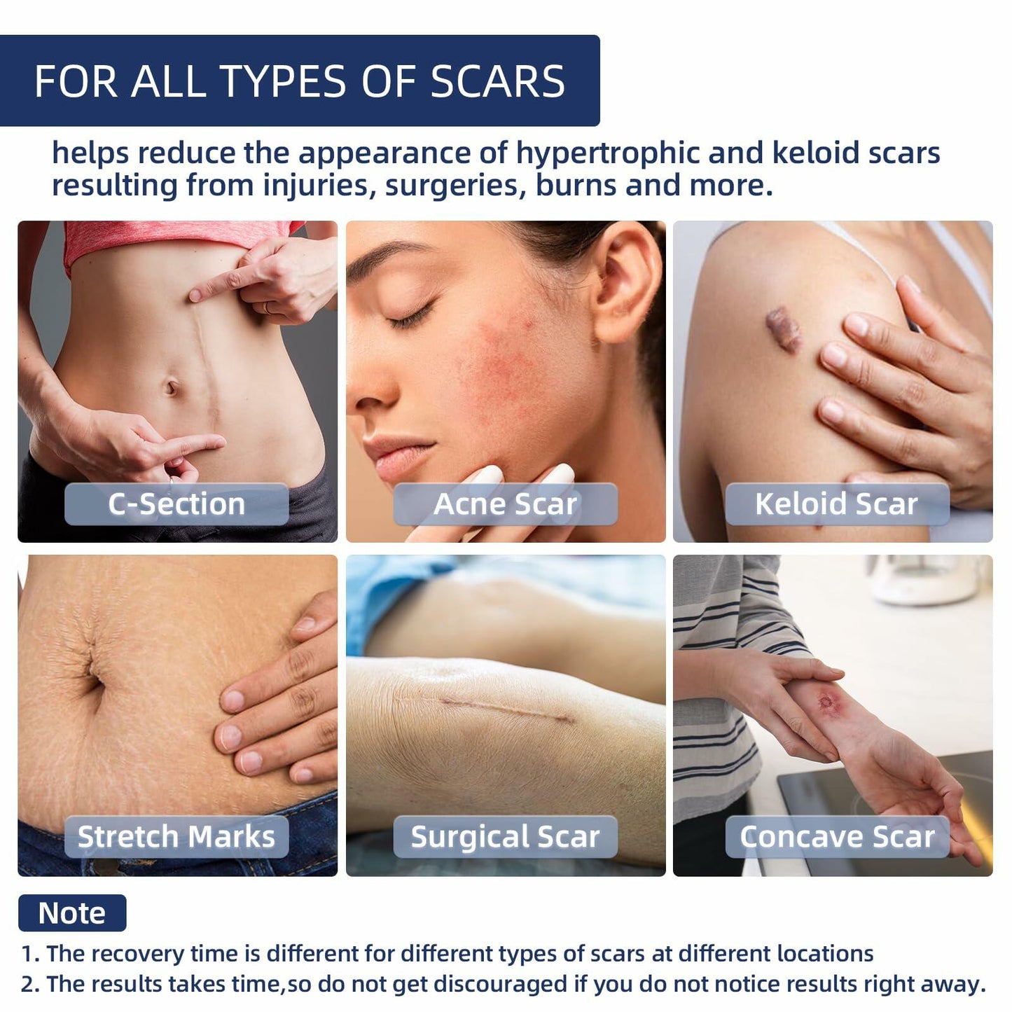 URAY Silicone Scar Tape Medical Grade 120"x1.5" Roll Reusable Extra Long